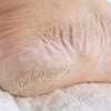 Cracked Heels
